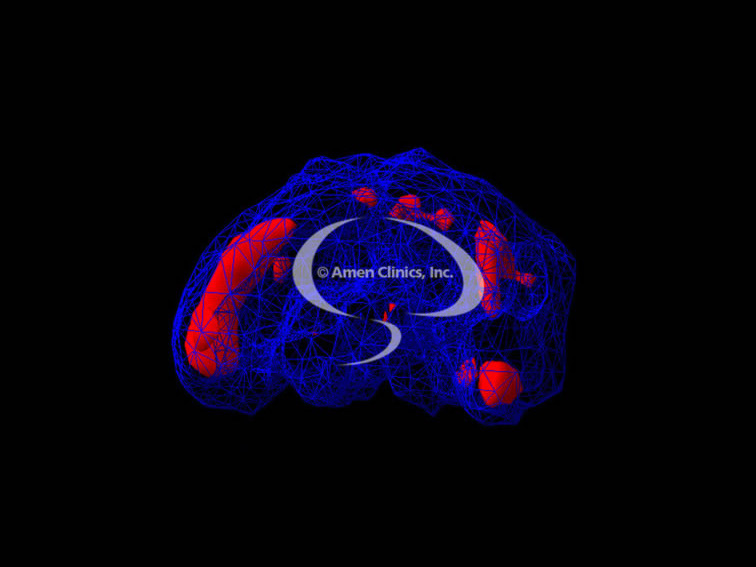 irlen-brain-scan-01