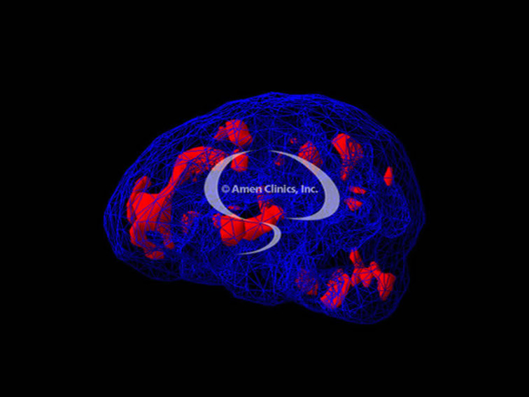 irlen-brain-scan-03
